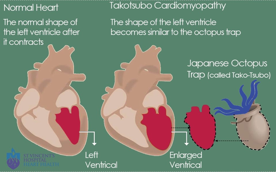  This diagram below shows Takotsubo cardiomyopathy. 